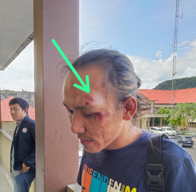 Adhio Septiawan, koordinator Seksi Wartawan Olahraga (SIWO) Persatuan Wartawan Indonesia (PWI) Kota Lubuklinggau mengalami luka lebam di wajah